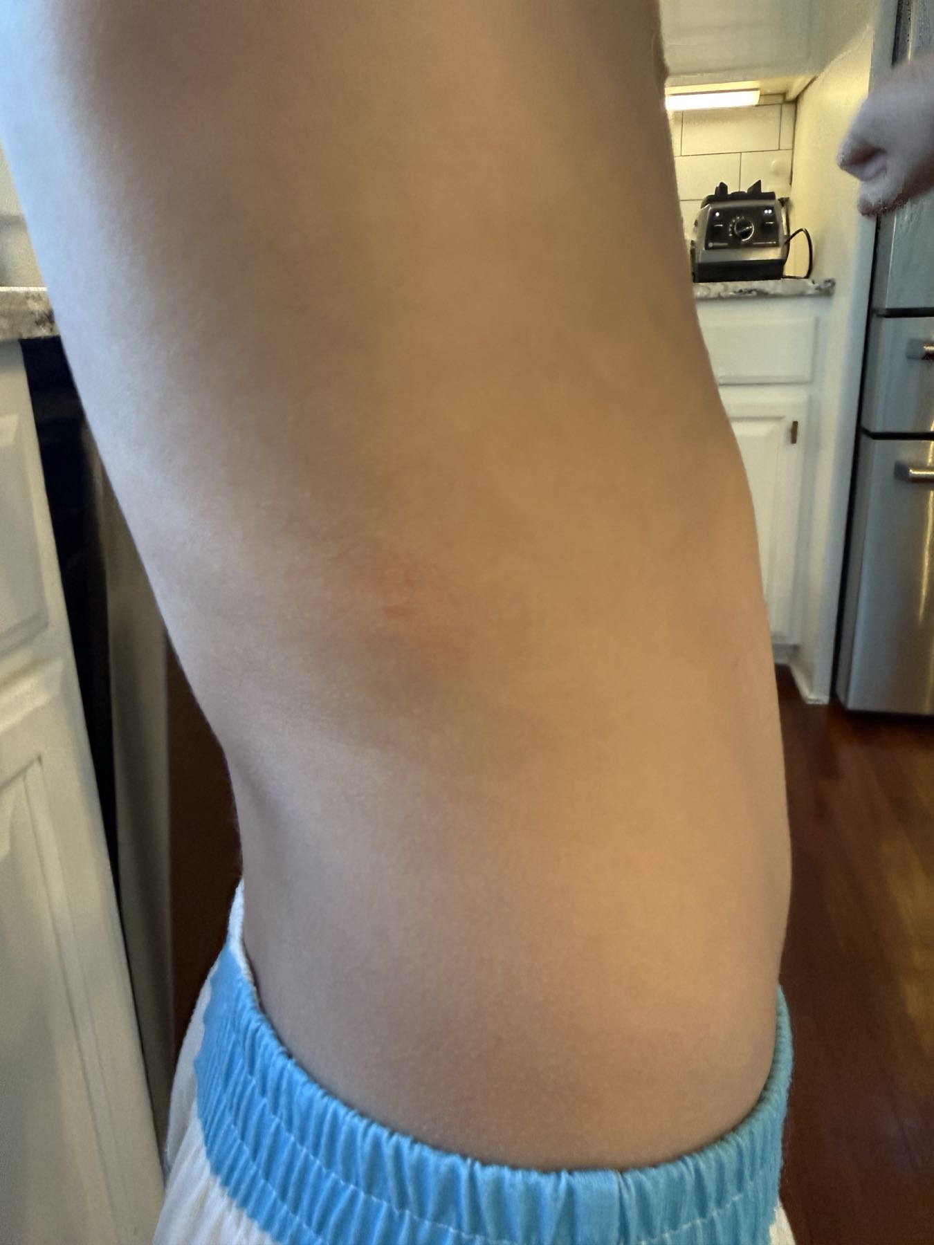 Bee sting site 40 minutes after CO2 Suit