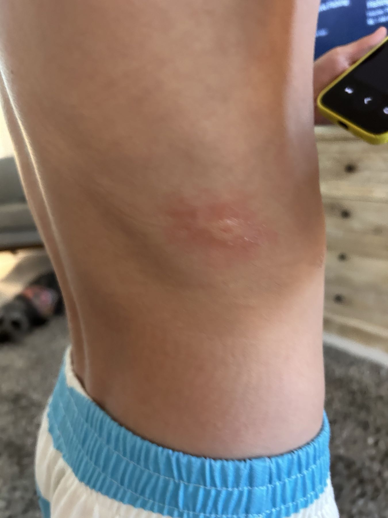 Bee sting site before CO2 Suit