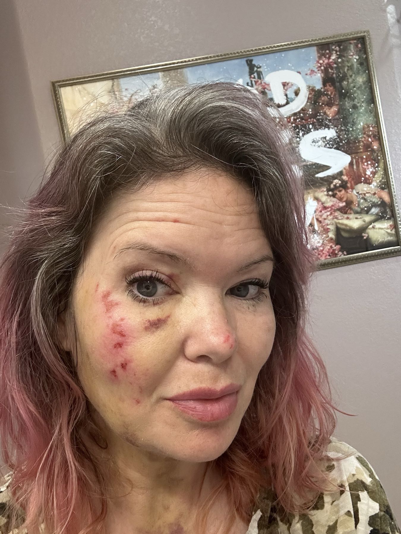 Road rash day 4 after CO2 Suit