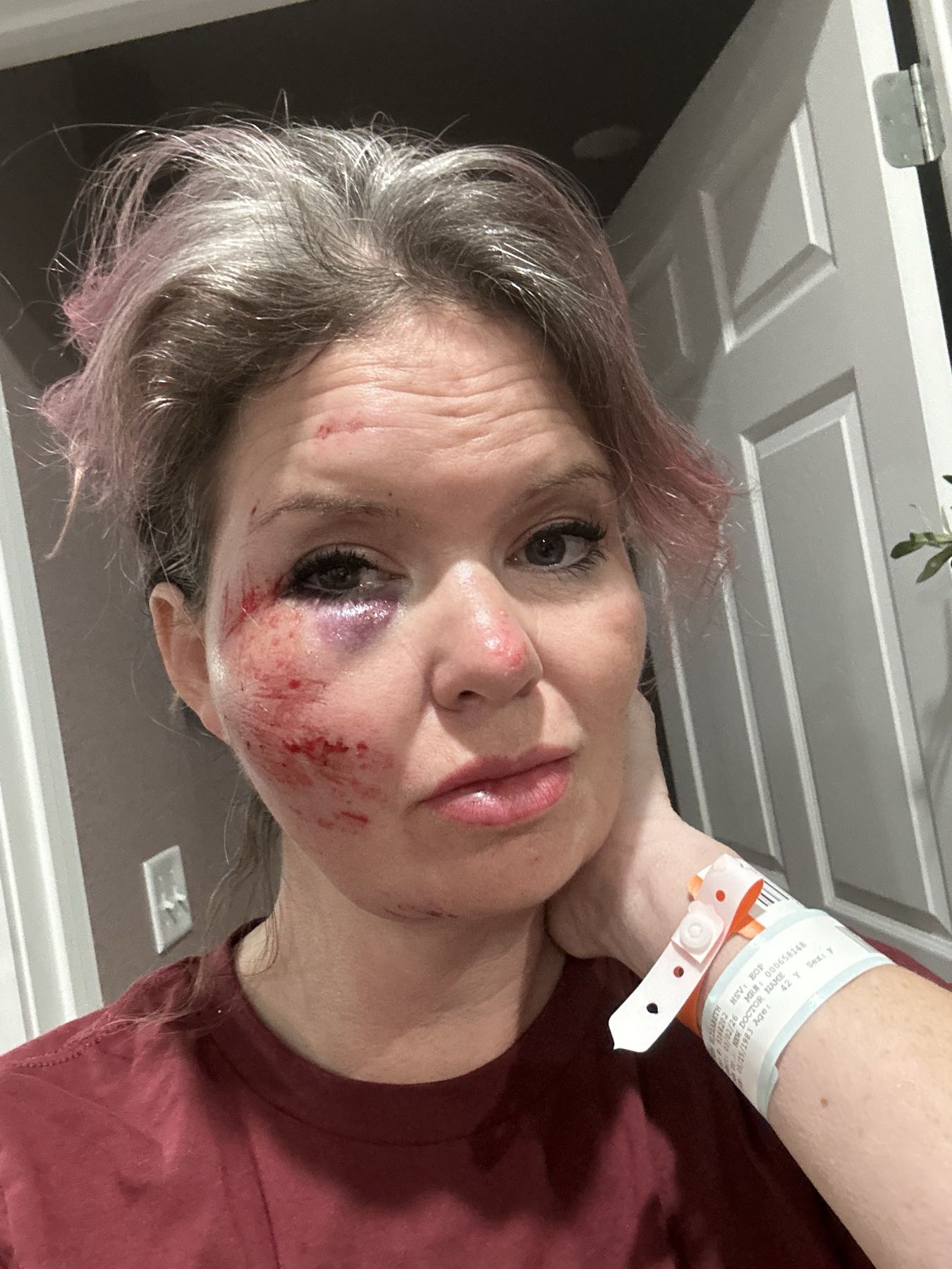 Road rash before CO2 Suit