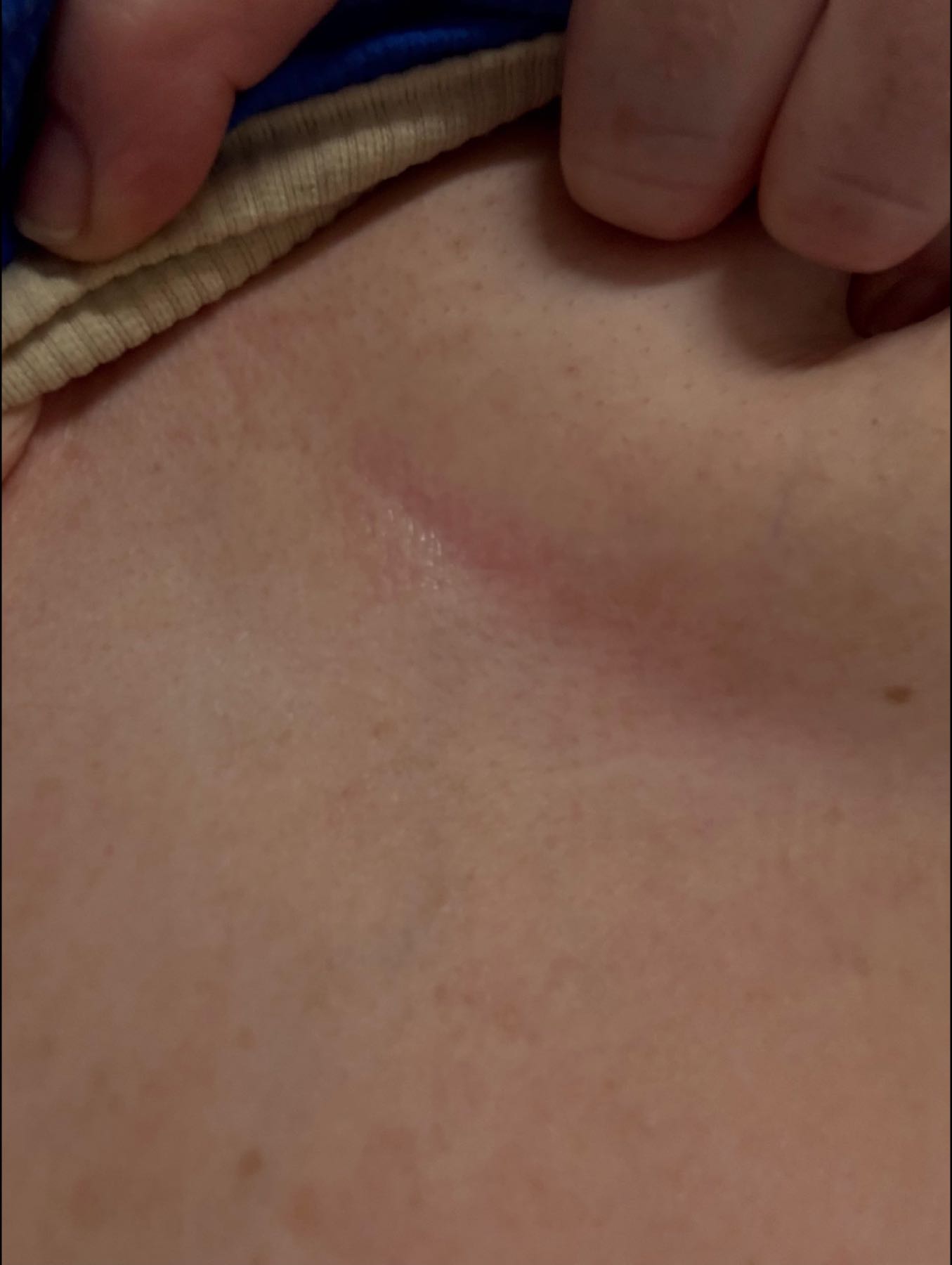 Inframammary eczema 3 days after CO2 Renew