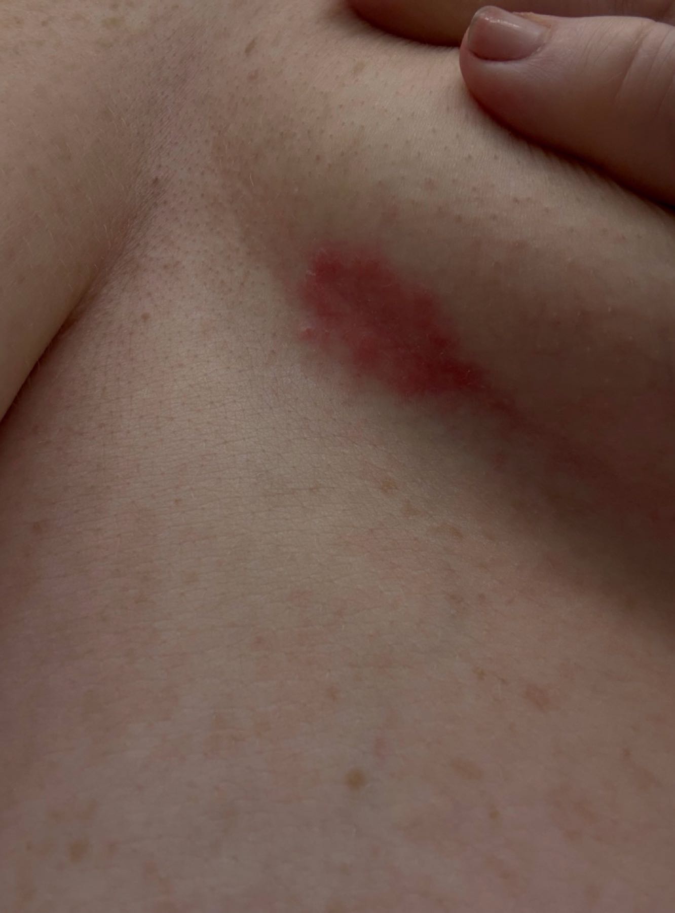 Inframammary eczema before CO2 Renew