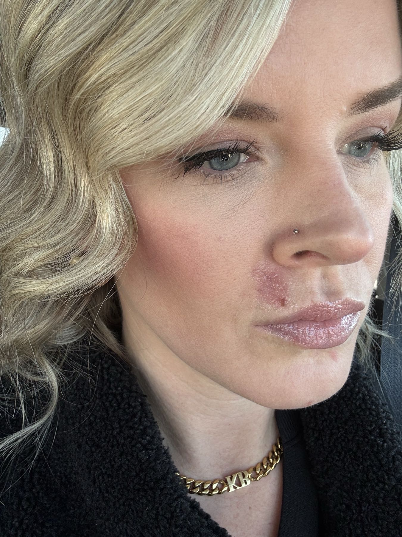 Post-excision wound site day 4 after CO2 Suit