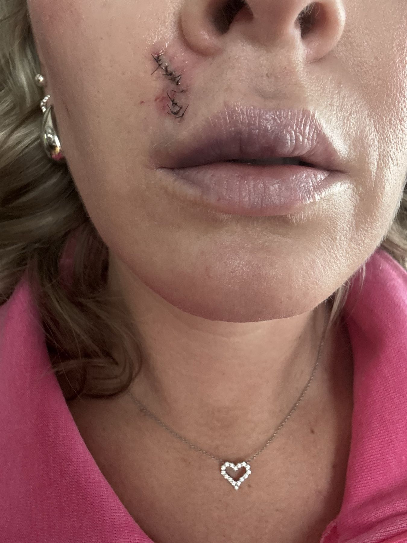 Post-excision wound site before CO2 Suit