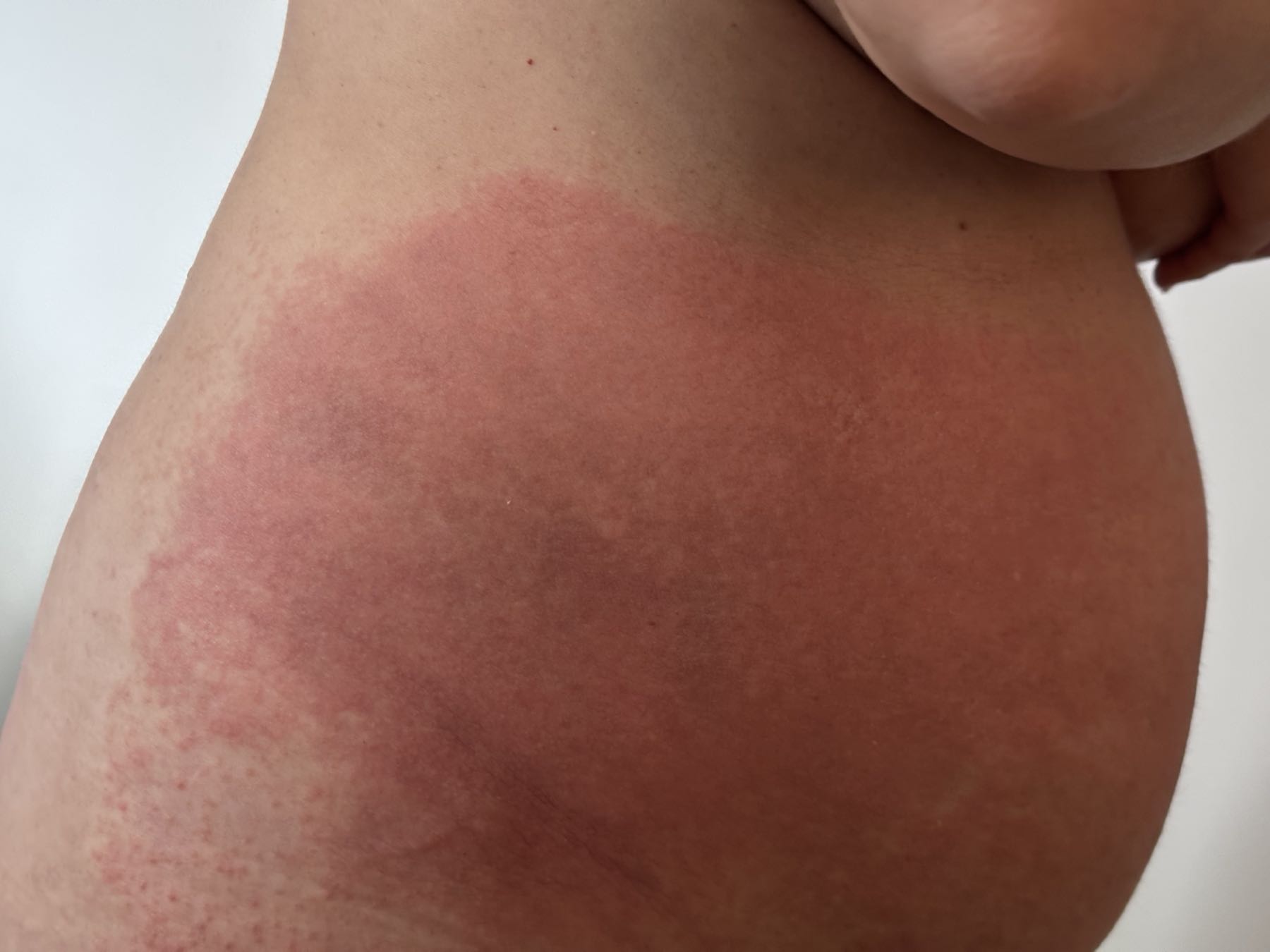 Chemical burn before CO2 Suit