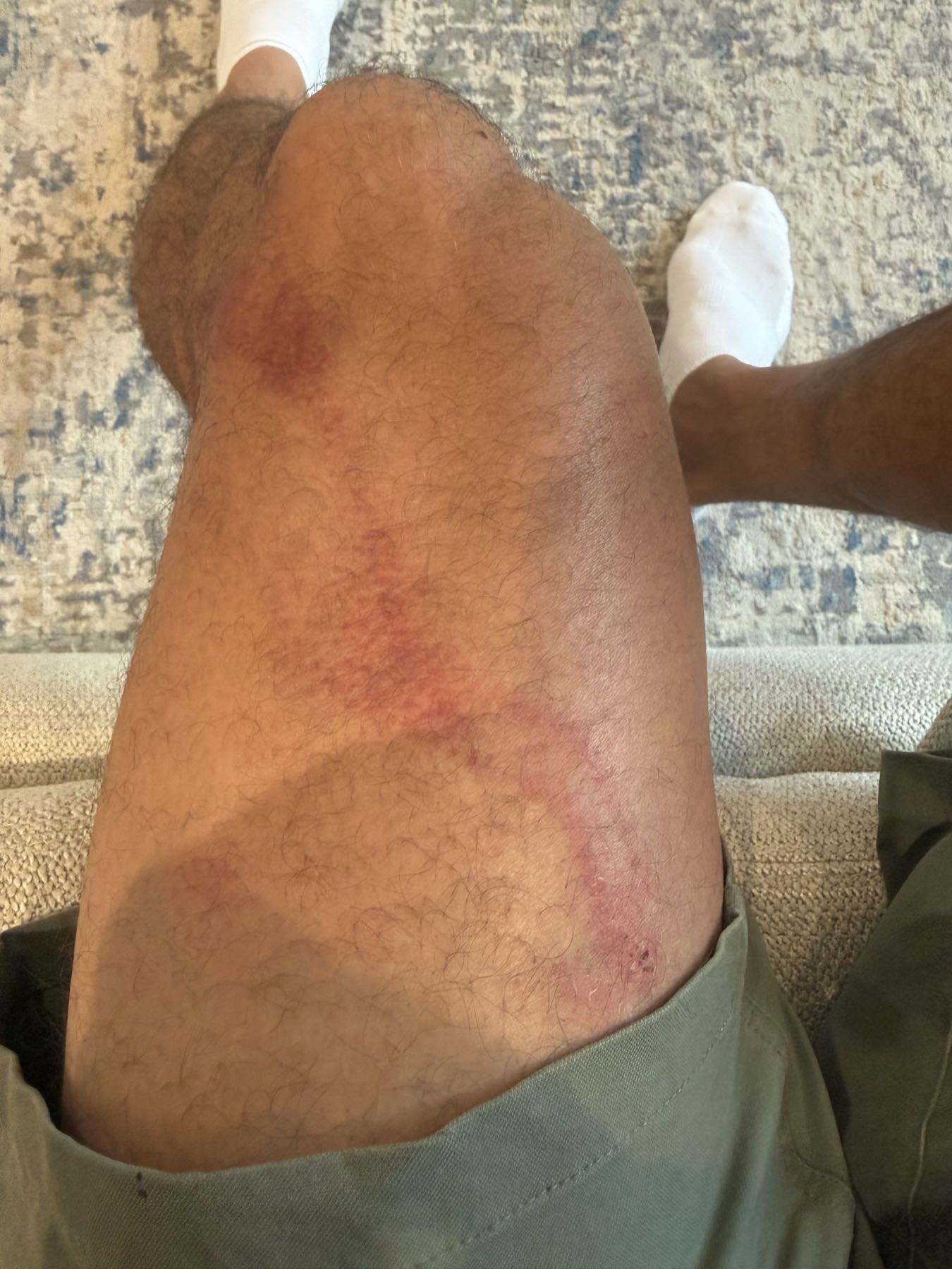 Leg bruising same day after CO2 Suit