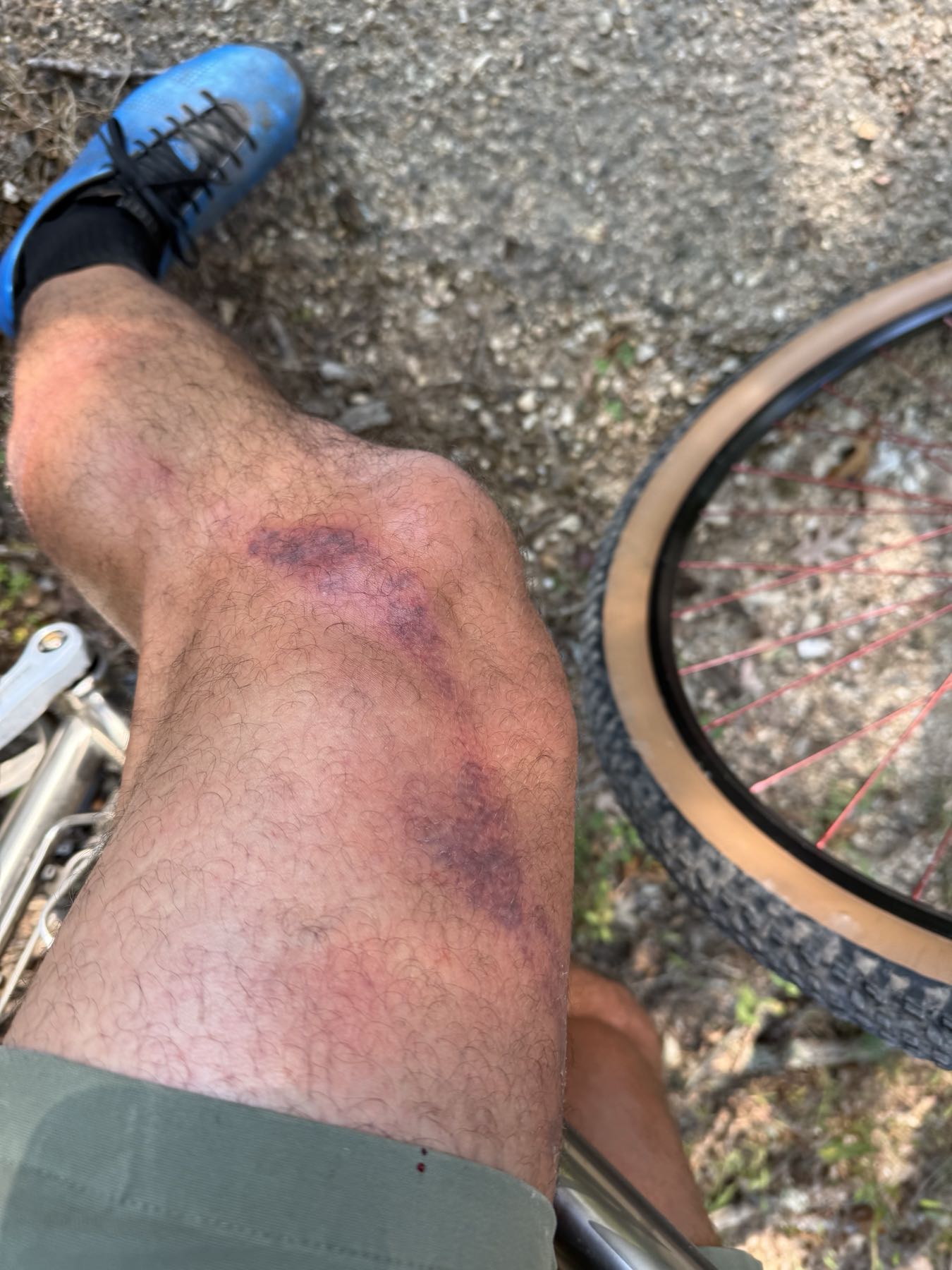 Leg bruising before CO2 Suit