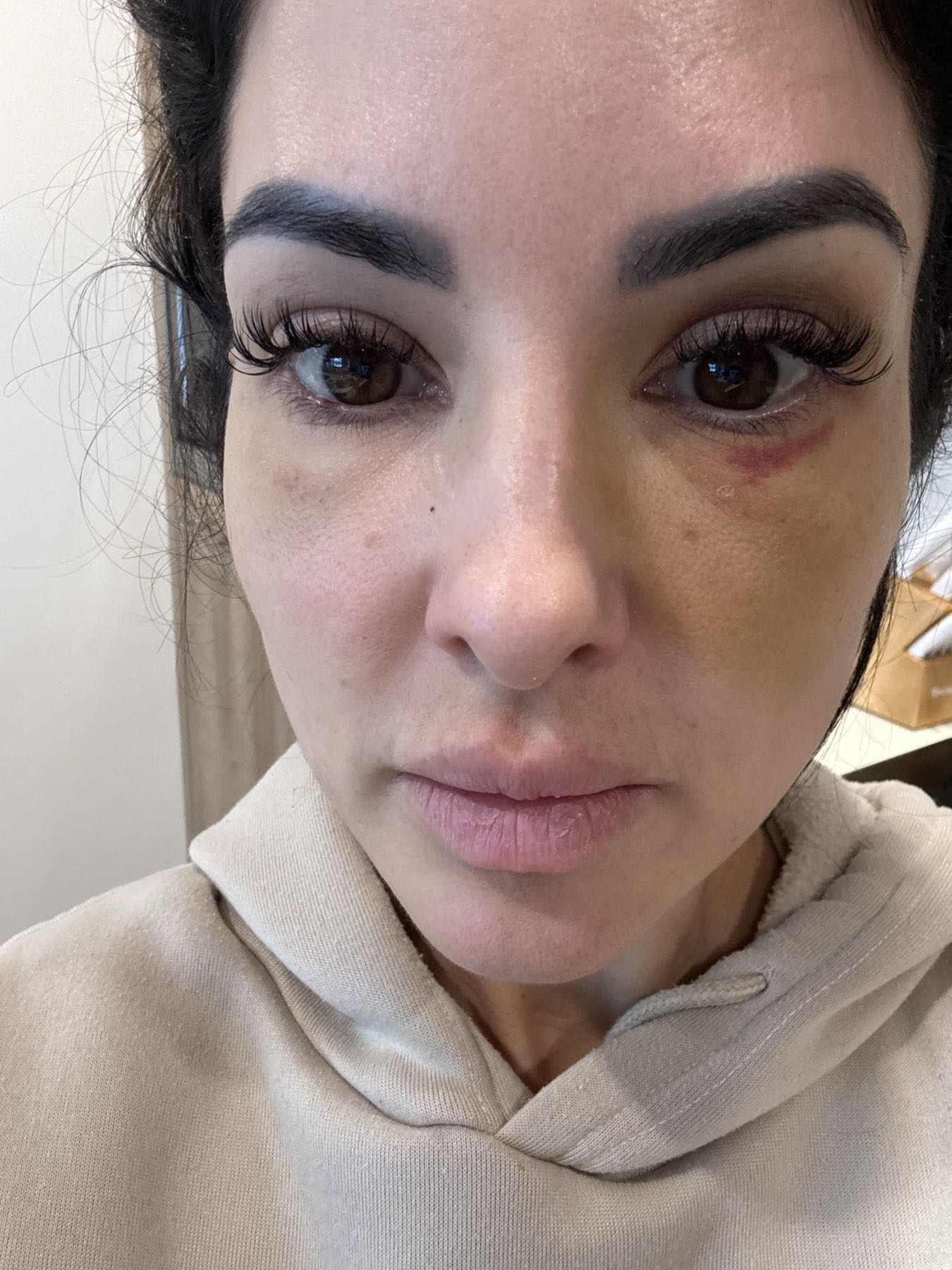 Post-procedure recovery day 4 after CO2 Suit