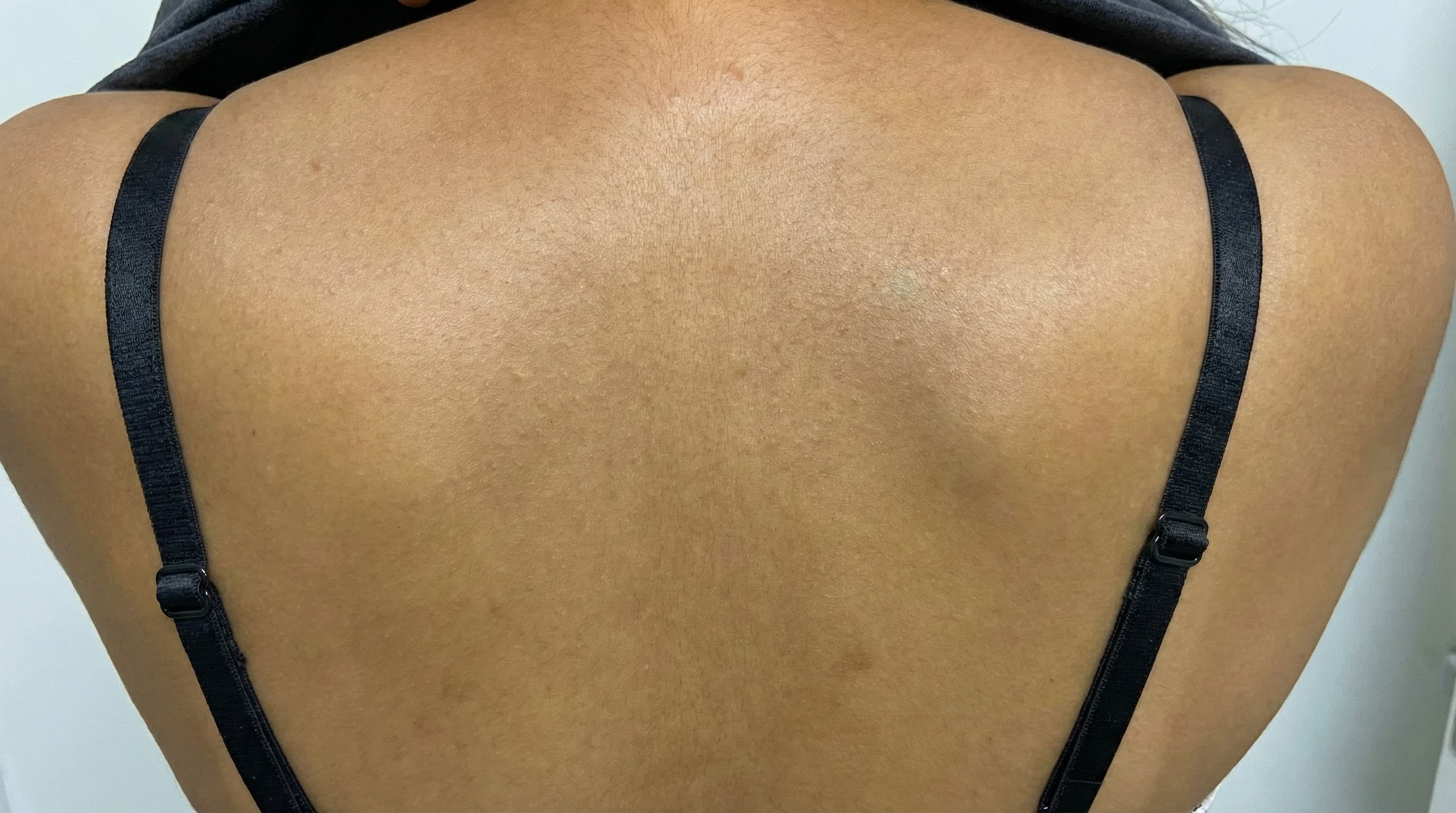 Back skin after ~2 months of CO2 Renew, acne case