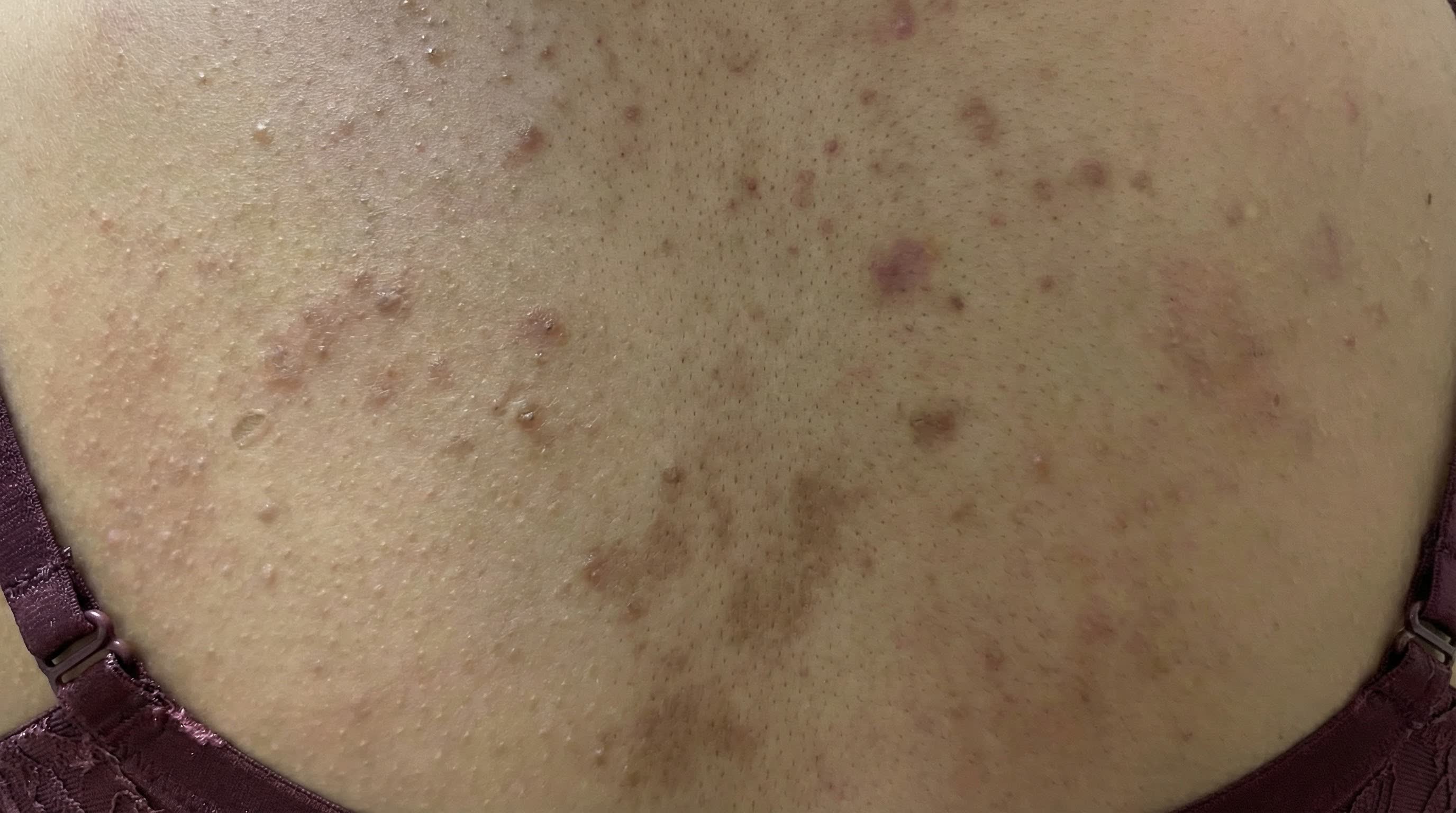 Back skin before CO2 Renew, acne case