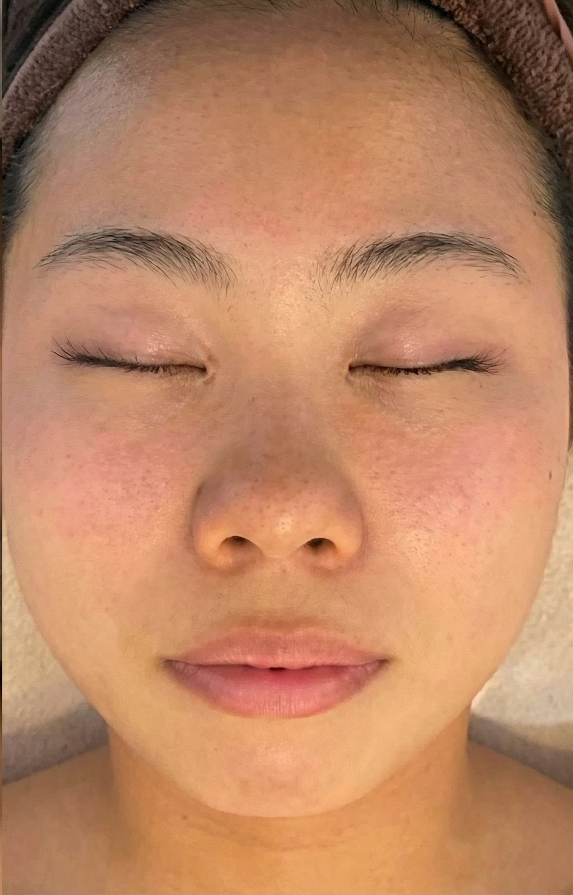 Face after ~2 months of CO2 Renew daily