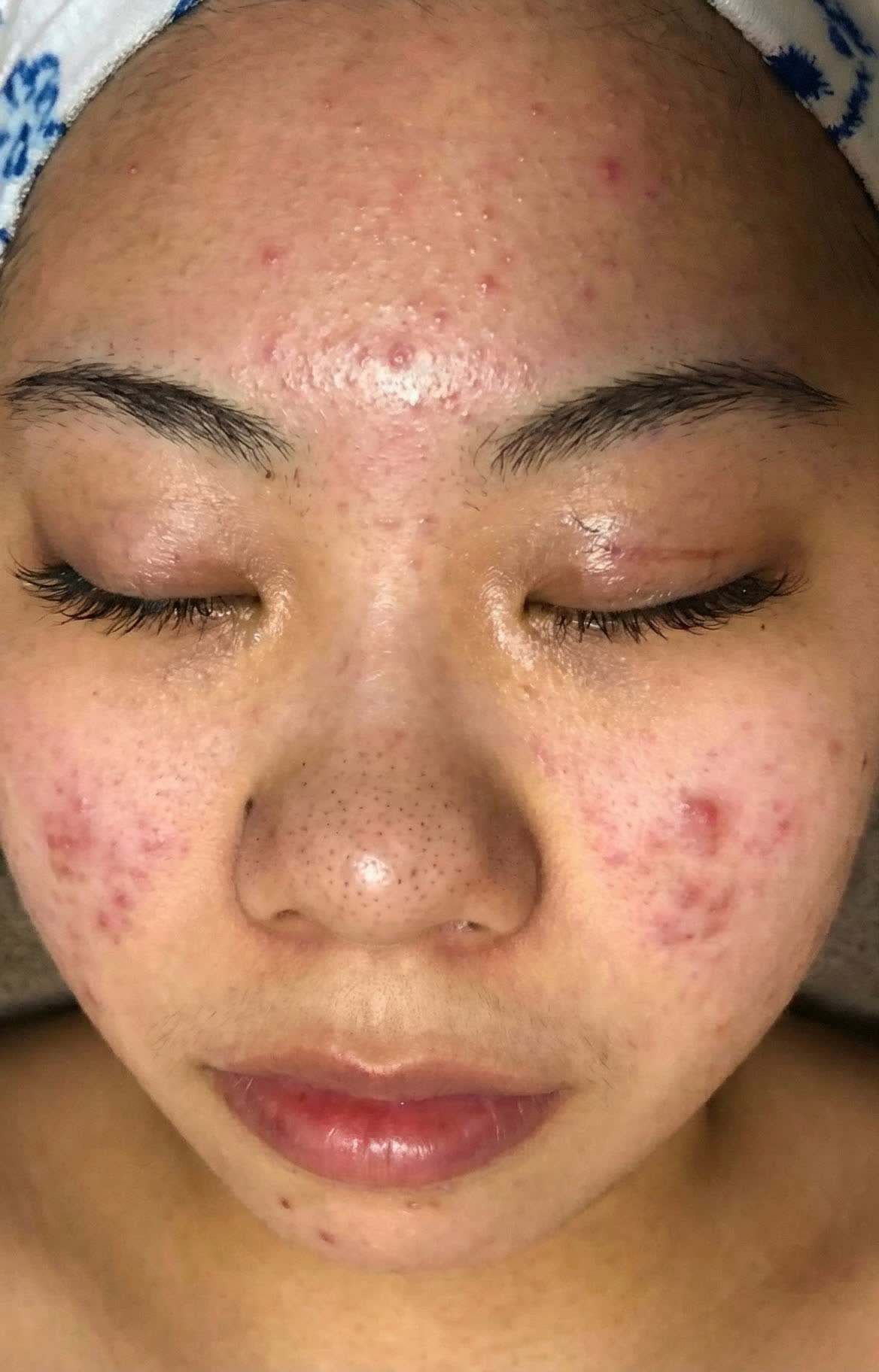 Face before, ~2 months of CO2 Renew