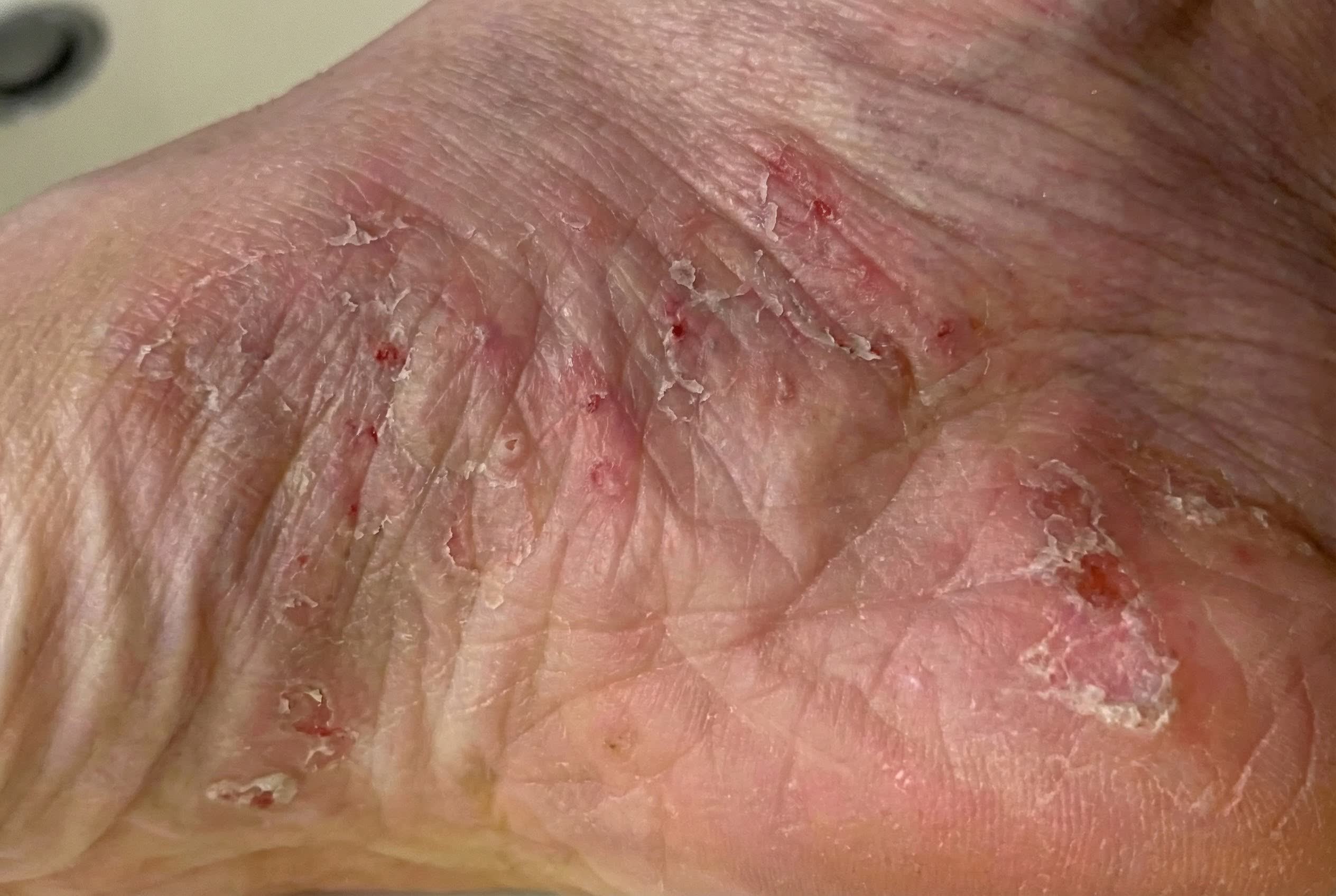 Foot before, dyshidrotic eczema case