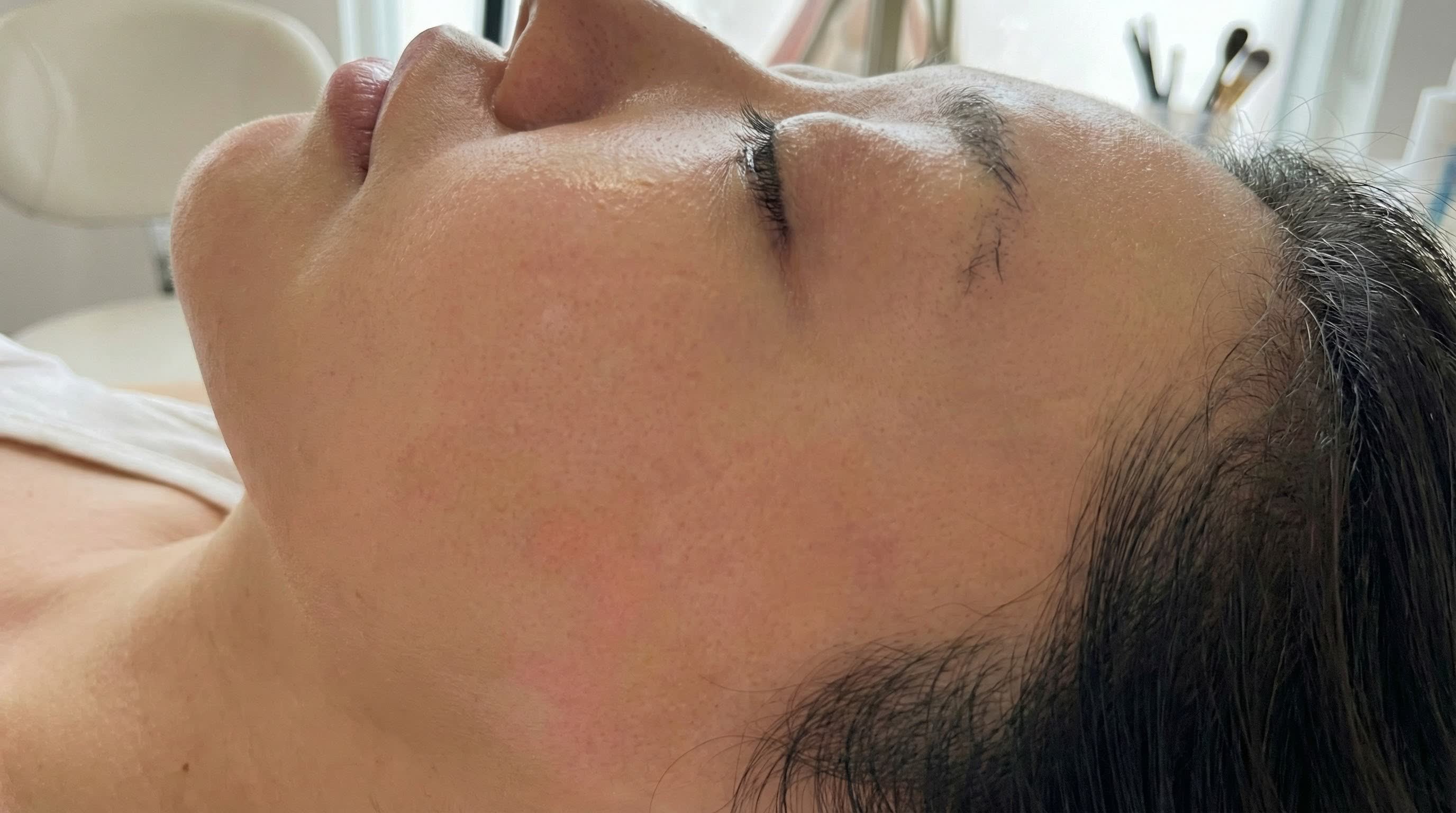 Post-lumpectomy scar, after 18 months of CO2 Renew + CO2 Suit