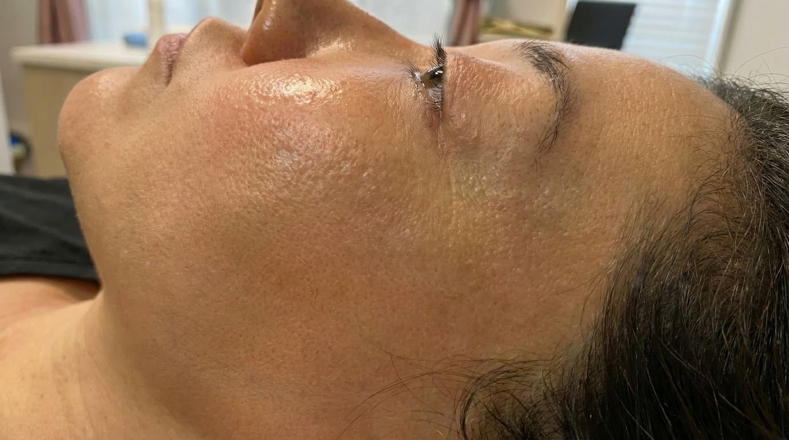 Post-lumpectomy scar, before